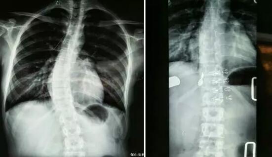 好好的脊柱怎么說彎就彎了？你竟然都沒發(fā)現(xiàn)……