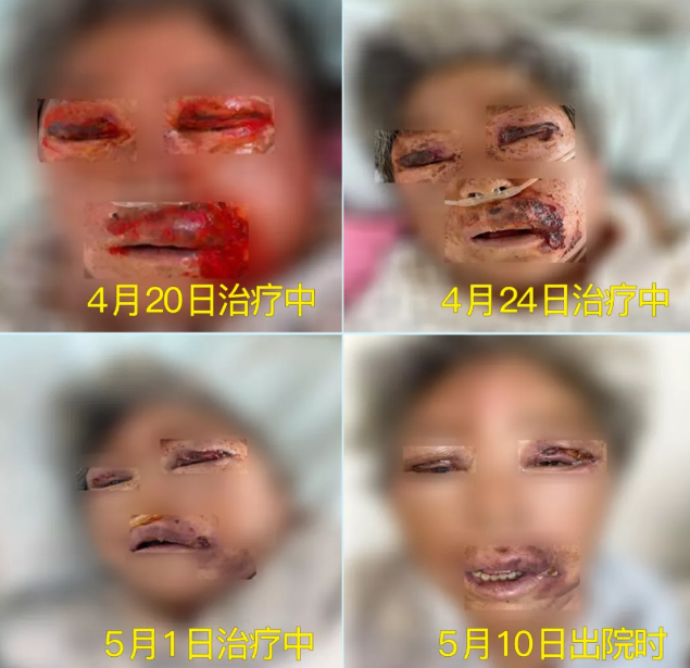 膿毒血癥（急性頜面部蜂窩組織炎）多學科聯(lián)合會診，幫助患者成功治愈！