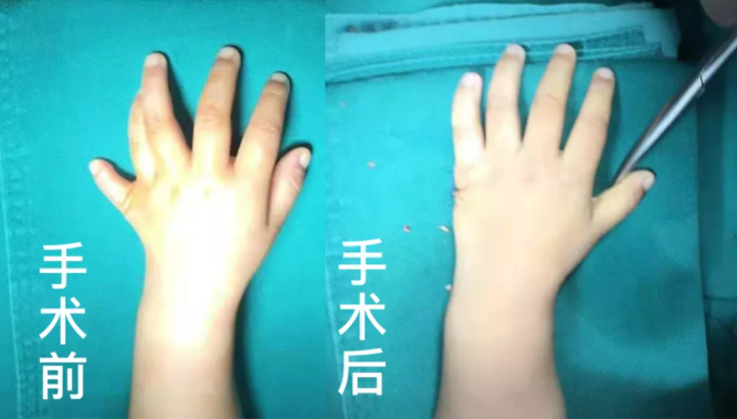【保山安利醫(yī)院】2歲小兒手、足多指（趾）成功修復(矯正）！