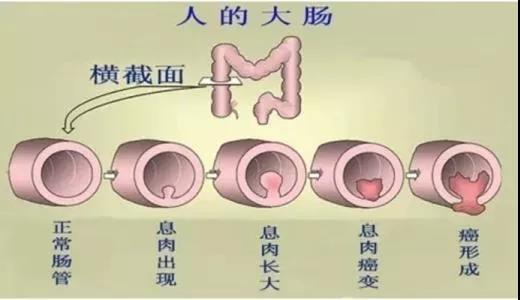 體檢發(fā)現(xiàn)腸息肉會(huì)癌變嗎？