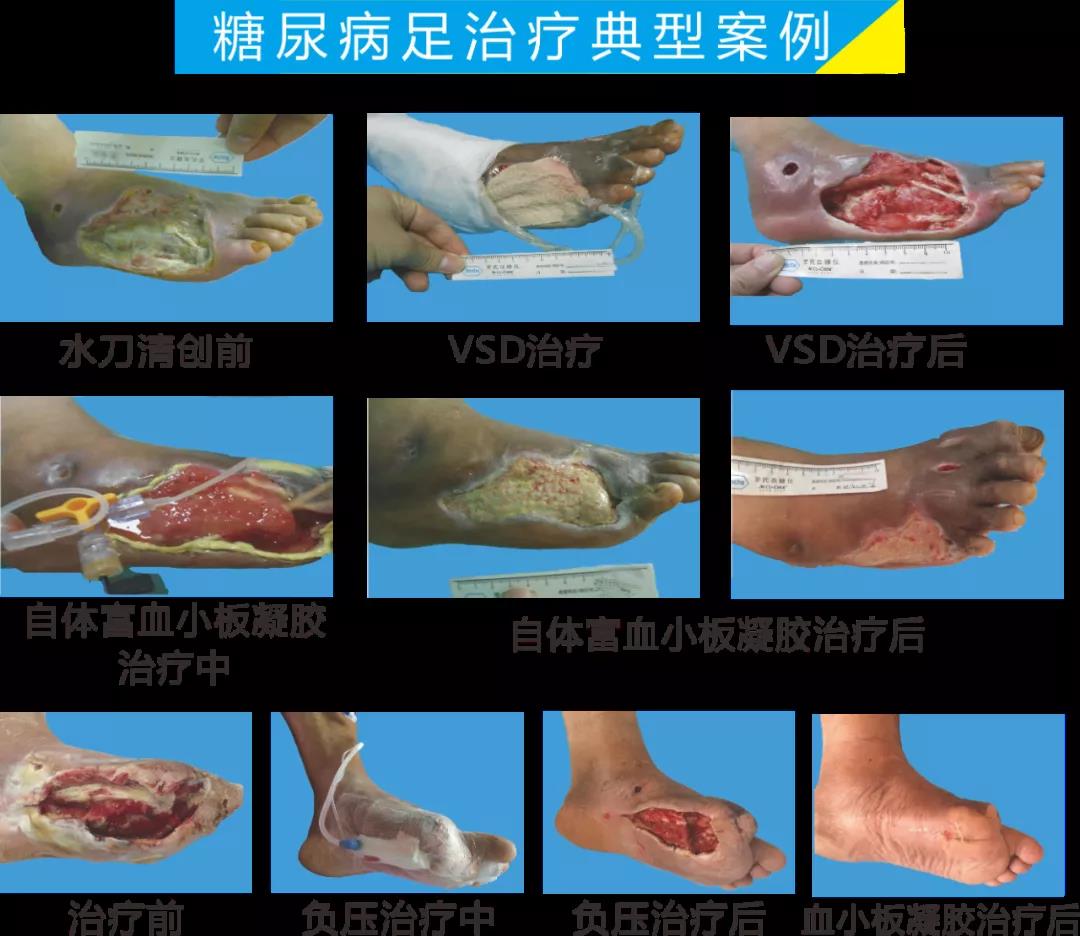 截肢、失明，甚至……，我們要做的是將糖尿病并發(fā)癥遏制在搖籃里！
