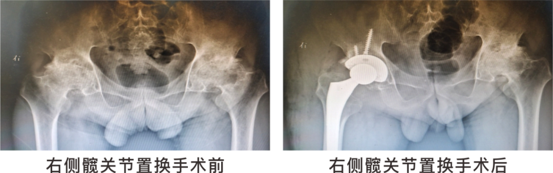 【保山安利醫(yī)院】長期飲酒導致雙側股骨頭壞死，髖關節(jié)置換后重獲運動功能！