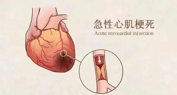 【保山安利醫(yī)院】11月20日“心梗救治日” 時間就是心肌，時間就是生命！